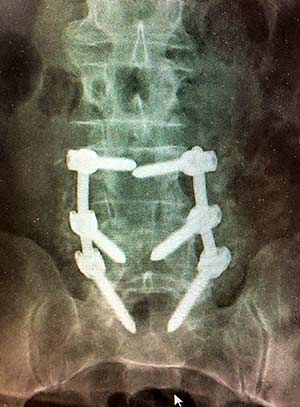 X-ray of Ernie Sollid's back
