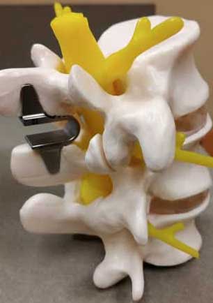 Model of spinal fusion implant