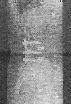 Spinal fusion x-ray